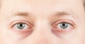Tilskud med omega-3 er effektivt mod tørre øjne