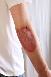 Psoriasis can be treated by avoiding alcohol – and taking supplements of fish oil and vitamin D