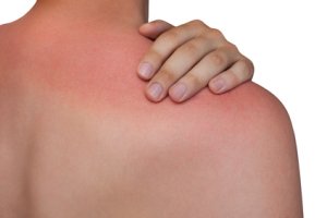 Ved solskoldning hjælper tilskud med D-vitamin mod hudskader