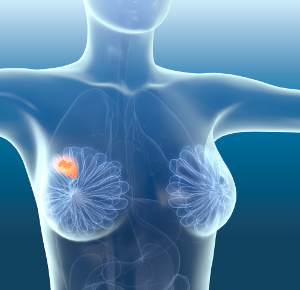 Bröstcancer: Blodets seleninnehåll förutsäger 10 års överlevnad