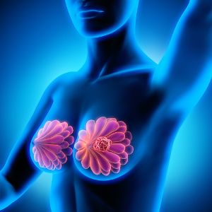 Bröstcancer: Utbredd brist på näringsämnen ökar risken för sjukdomen och livshotande metastaser