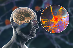 Alzheimers: mer omega-3 kan halvera risken