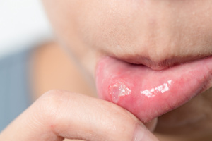 Lippenbläschen können mit einem Vitamin-D-Mangel zusammenhängen