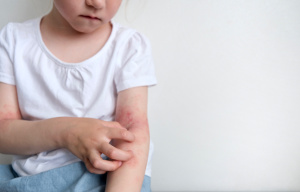 Increased risk of atopic dermatitis caused by vitamin D deficiency in early childhood