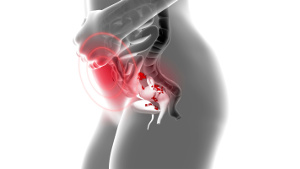Fiskeolie lindrer smerter ved endometriose Fiskeolie lindrer smerter ved endometriose