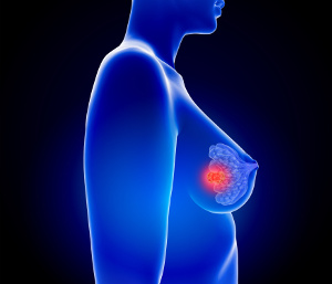 Ved brystkræft booster D-vitamintilskud kemoterapis effekt med 79 % Ved brystkræft booster D-vitamintilskud kemoterapis effekt med 79 %